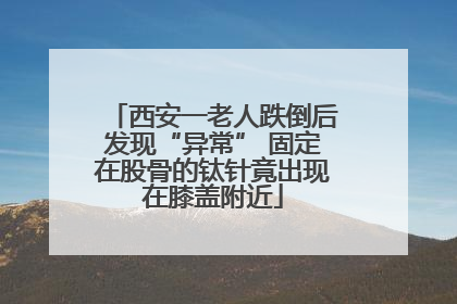 西安一老人跌倒后发现“异常” 固定在股骨的钛针竟出现在膝盖附近